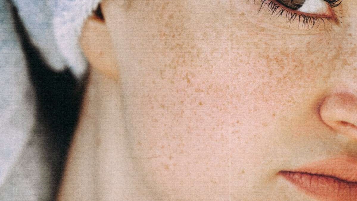 Mujer pecas diagnóstico facial